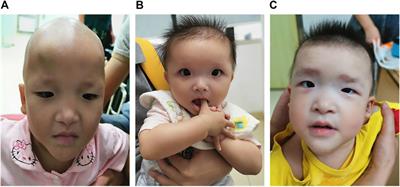 Three Novel De Novo ZEB2 Variants Identified in Three Unrelated Chinese Patients With Mowat-Wilson Syndrome and A Systematic Review